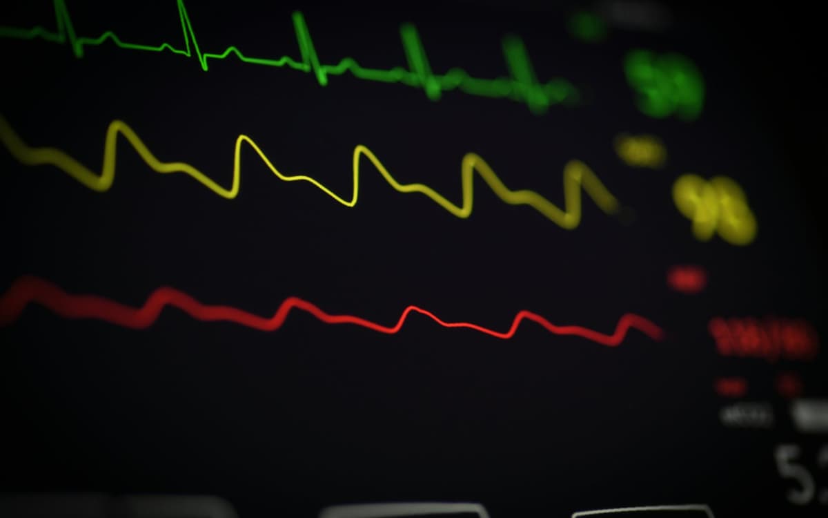 Tracés d'électrocardiogramme sur un écran de surveillance